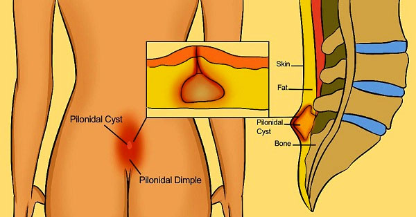 DO NOT IGNORE THIS! This may BE THE HIDDEN REASON OF YOUR LOWER BACK PAIN